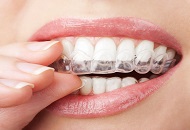 Treatment for Bruxism
