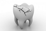 Cracked Tooth Syndrome