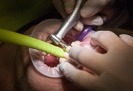 Complications of Gum Diseases