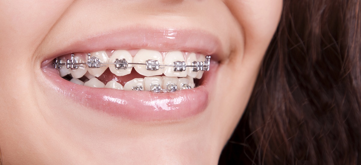 Orthodontics in Dubai